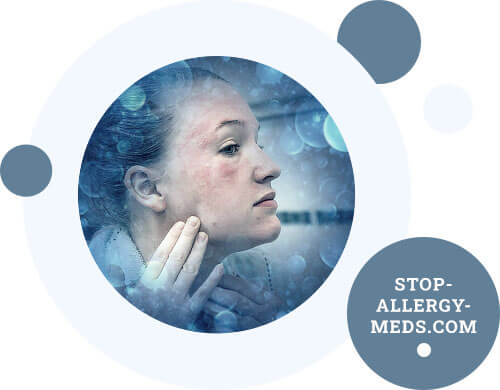 Allergies and allergic diseases